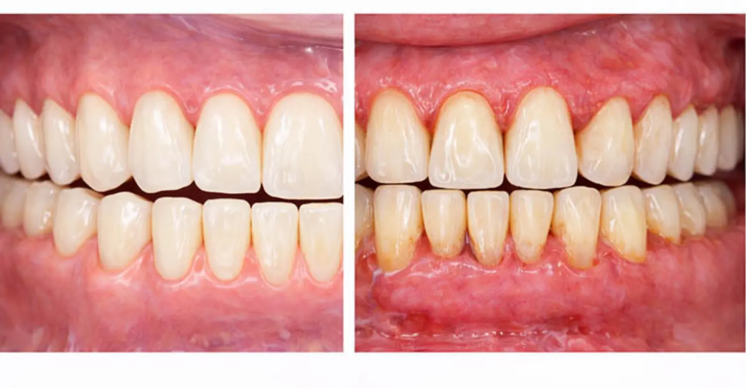 Gums 2